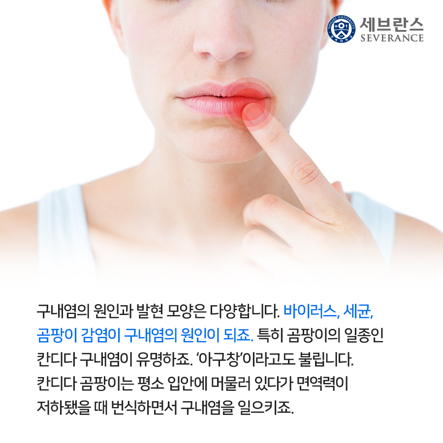 구내염의 원인과 발현 모양은 다양합니다. 바이러스, 세균, 곰팡이 감염이 구내염의 원인이 되죠. 특히 곰팡이의 일종인 칸디다 구내염이 유명하죠. ‘아구창’이라고도 불립니다. 칸디다 곰팡이는 평소 입안에 머물러 있다가 면역력이 저하됐을 때 번식하면서 구내염을 일으키죠.