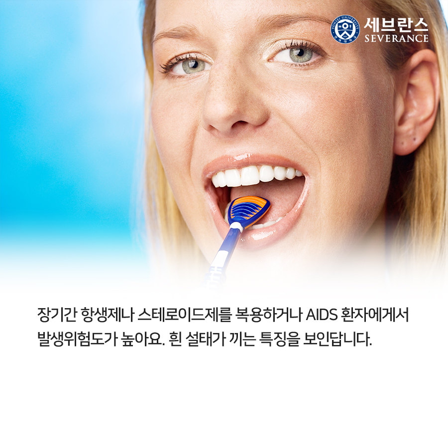 장기간 항생제나 스테로이드제를 복용하거나 AIDS 환자에게서 발생위험도가 높아요. 흰 설태가 끼는 특징을 보인답니다. 