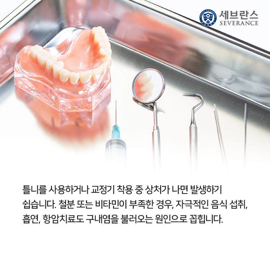 틀니를 사용하거나 교정기 착용 중 상처가 나면 발생하기 쉽습니다. 철분 또는 비타민이 부족한 경우, 자극적인 음식 섭취, 흡연, 항암치료도 구내염을 불러오는 원인으로 꼽힙니다.