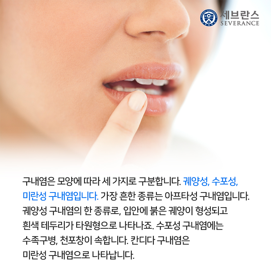 구내염은 모양에 따라 세 가지로 구분합니다. 궤양성, 수포성, 미란성 구내염입니다. 가장 흔한 구내염 종류는 아프타성 구내염입니다. 궤양성 구내염의 한 종류로, 입안에 붉은 궤양이 형성되고 흰색 테두리가 타원형으로 나타나죠. 수포성 구내염에는 수족구병, 천포창이 속합니다. 칸디다 구내염은 미란성 구내염으로 나타납니다. 