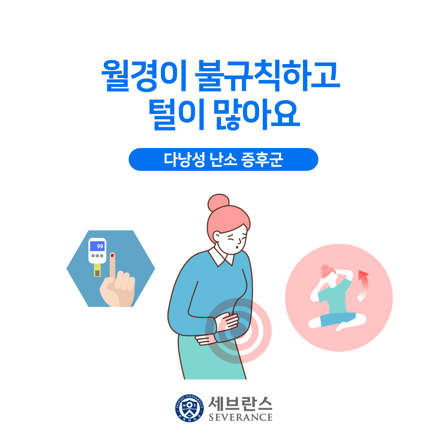 월경이 불규칙하고 털이 많아요 - 다낭성 난소 증후군