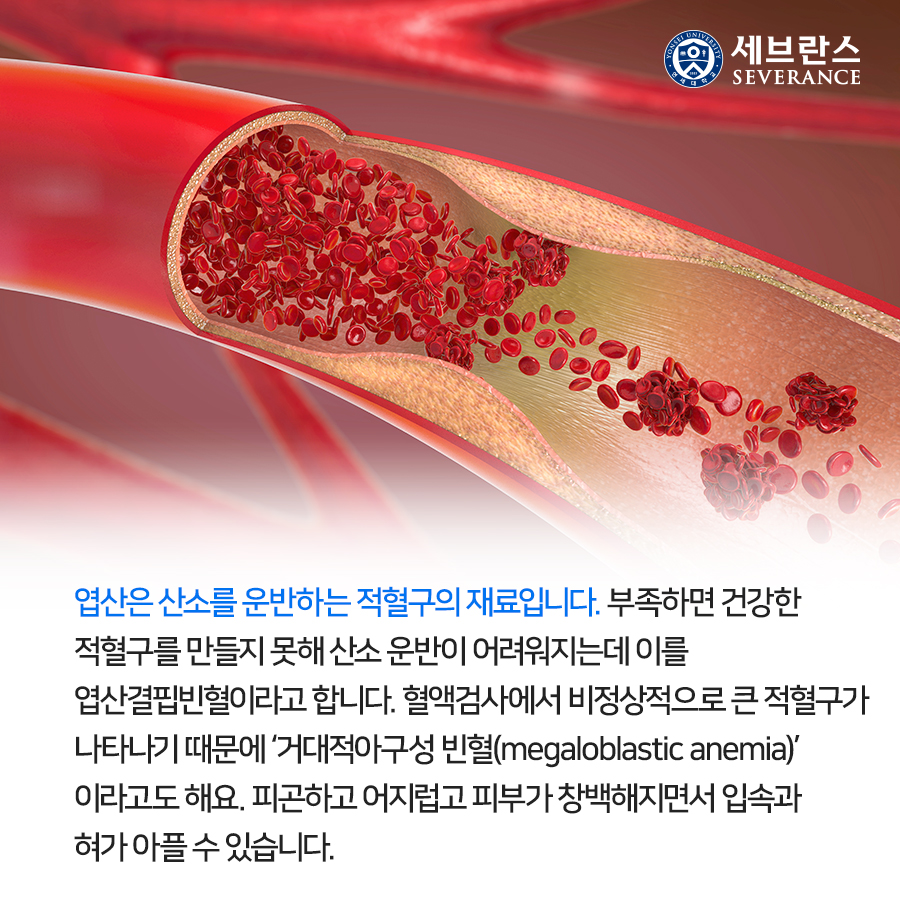 엽산은 산소를 운반하는 적혈구의 재료입니다. 부족하면 건강한 적혈구를 만들지 못해 산소 운반이 어려워지는데 이를 엽산결핍빈혈이라고 합니다.  혈액검사에서 비정상적으로 큰 적혈구가 나타나기 때문에 ‘거대적아구성 빈혈(megaloblastic anemia)’이라고도 해요. 피곤하고 어지럽고 피부가 창백해지면서 입속과 혀가 아플 수 있습니다.